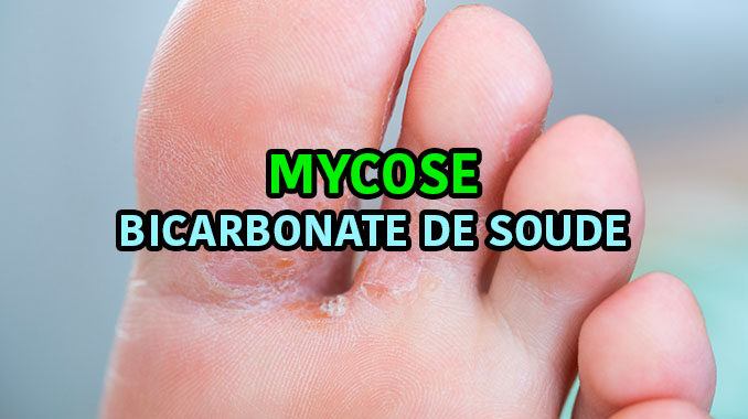 mycose au pied avec bicarbonate de soude