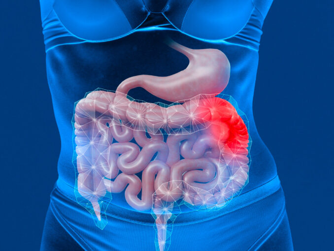 La maladie de Crohn