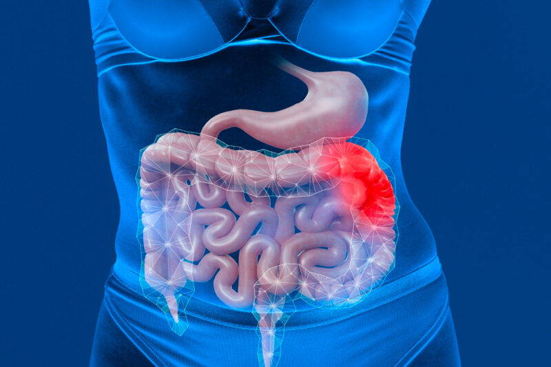 La maladie de Crohn