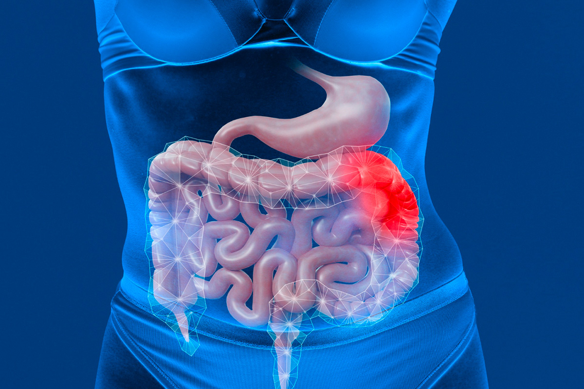 La maladie de Crohn Causes, Symptômes, Traitements