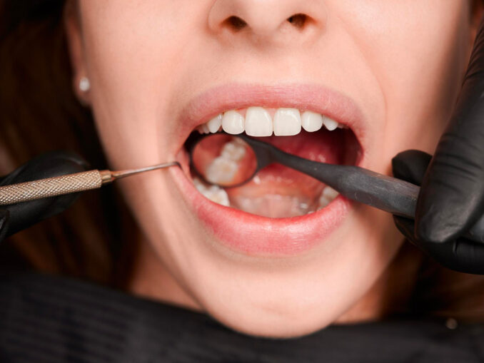 les caries dentaires