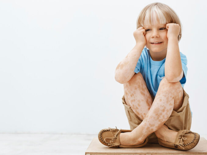 Vitiligo chez les enfants