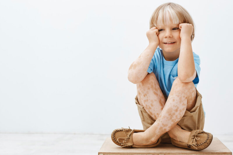 Vitiligo chez les enfants