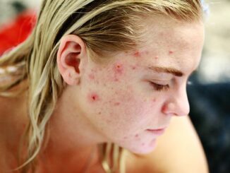 Acné : soins naturels à tester