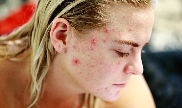 Acné : soins naturels à tester