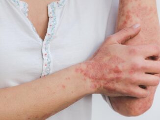 Quelle est la différence entre eczéma et psoriasis ?