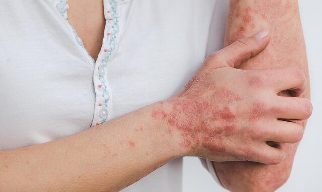 Quelle est la différence entre eczéma et psoriasis ?