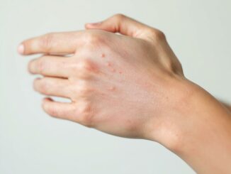 Quelle est la différence entre allergie cutanée et urticaire ?