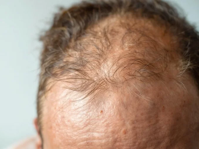 Chute de cheveux saisonnière : quoi faire (et quand s’inquiéter)